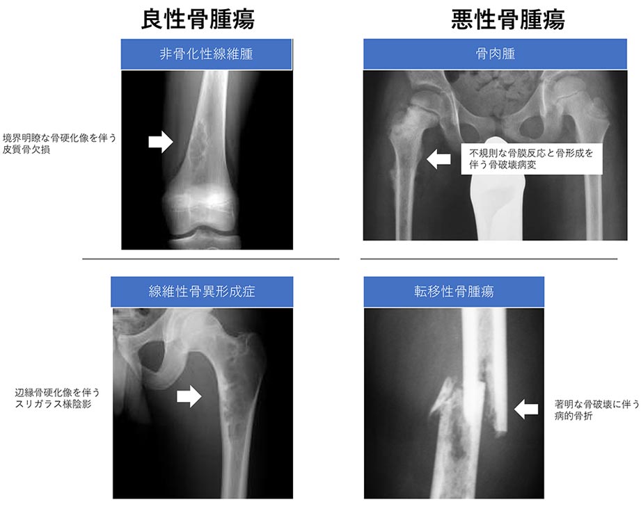 良性骨腫瘍 | 悪性骨腫瘍