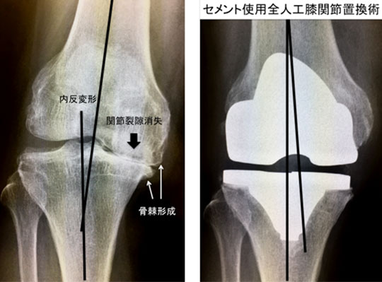 セメント使用全人工膝関節置換術