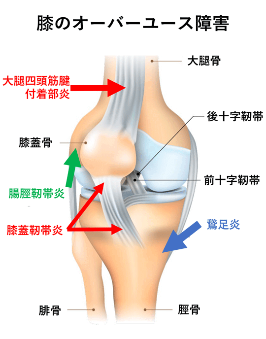 膝のオーバーユース障害