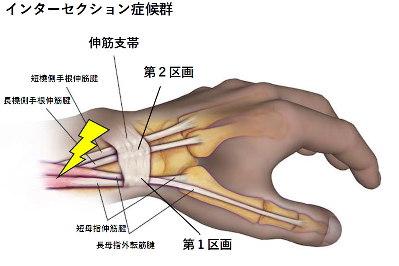 インターセクション症候群