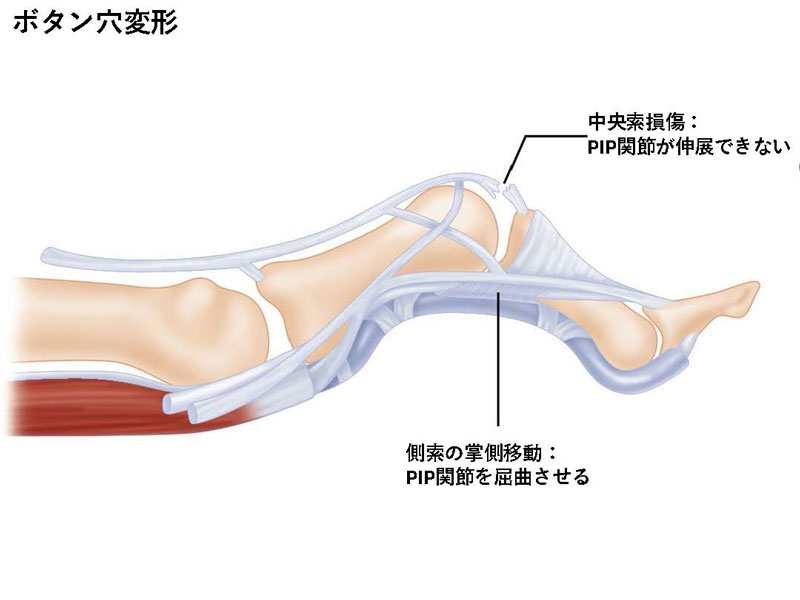 指伸筋腱中央索断裂(central slip rupture)・ボタン穴変形(Boutonniere deformity)