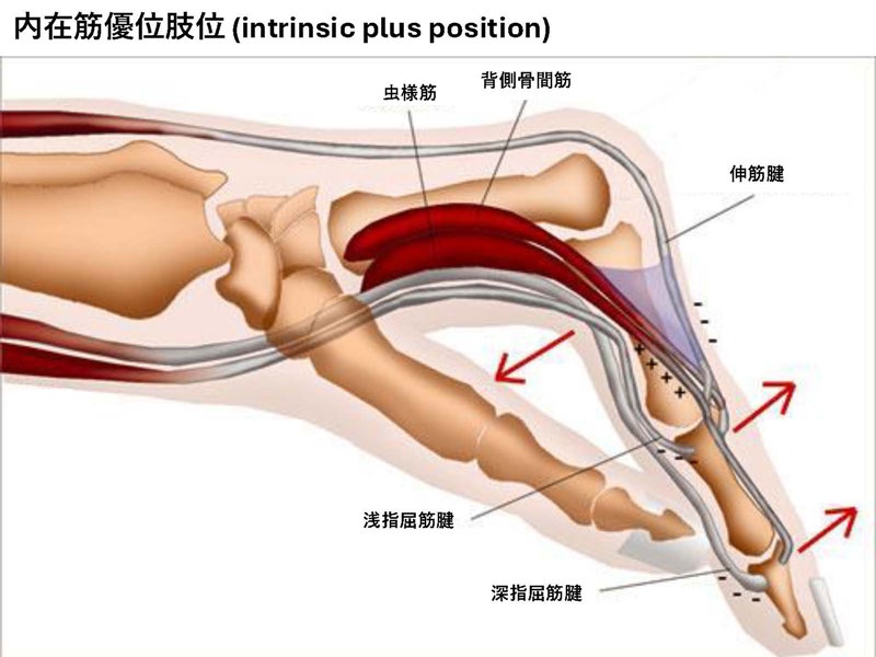 内在筋優位肢位